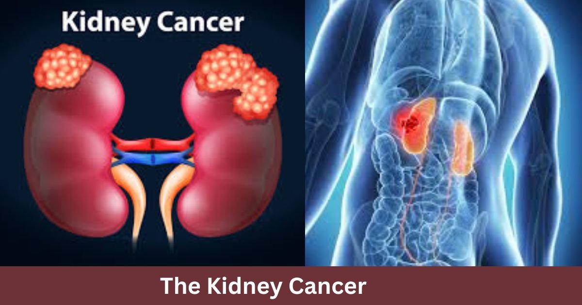 The Kidney Cancer